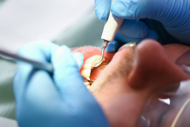 Best Emergency Tooth Extraction in Johnsonburg, PA